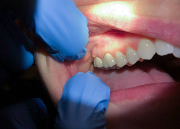 Best Emergency Dentist for Lost Fillings or Crowns in Ponder, TX
