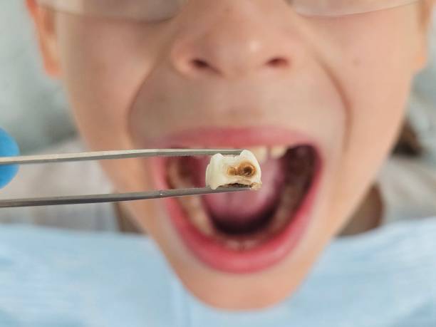 Best Emergency Dental Care for Abscessed Tooth in Ponder, TX
